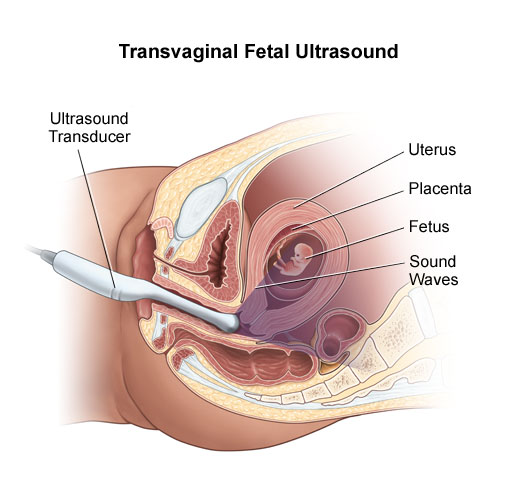 transvaginal ultrasound