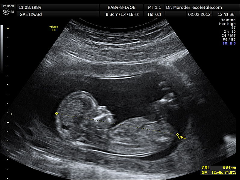 ultrasound, sonogram baby picture