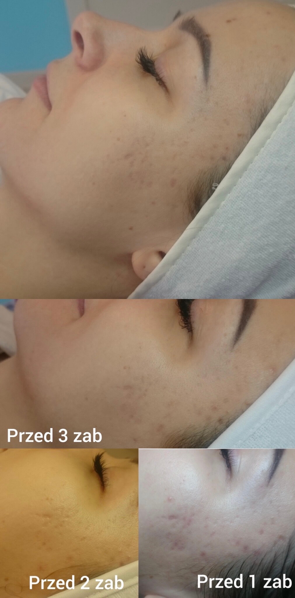 remove acne scars, accutane, get rid of acne, acne before and after