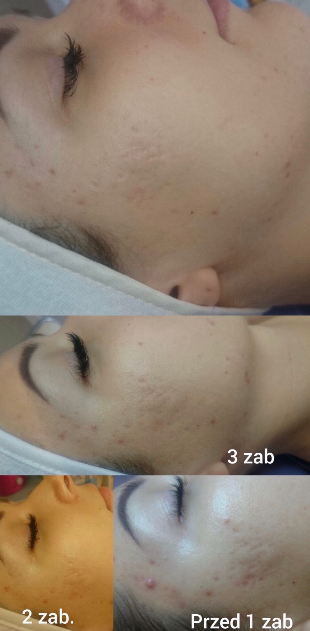 remove acne scars accutane-2